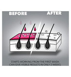 Nizoral Dandruff Shampoo - 100 ml