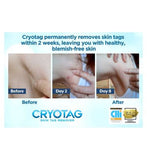 Cryotag Skin Tag Remover