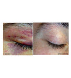 Kelo-Cote Scar gel - 6g