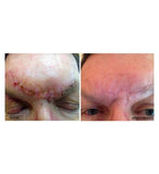 Kelo-Cote Scar gel - 6g