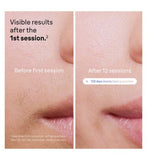 Braun Skin i·expert, Smart IPL Hair Removal System With Connected App & 4 Attachment Caps - PL7387