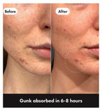 Hero Mighty Patch Original Spot Patches, 36 Hydrocolloid Pimple Patches