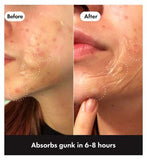 Hero Mighty Patch Surface Spot Patches, 10 Hydrocolloid Acne Patches