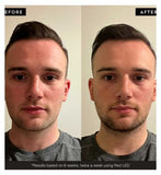 BARBER PRO PHOTON LED Light Therapy Facial Mask