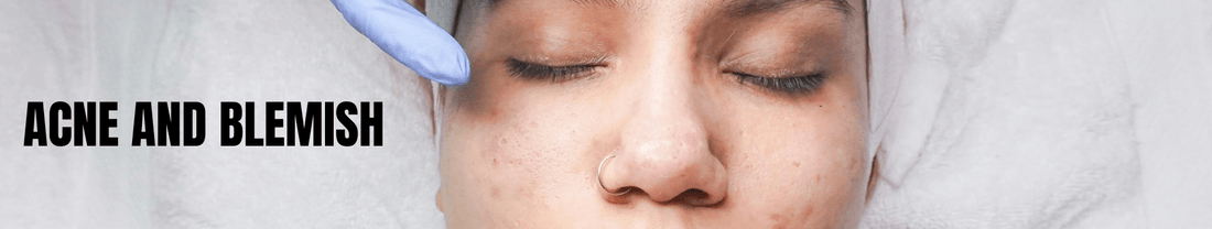 Acne and Blemish - Brandlistry Nigeria