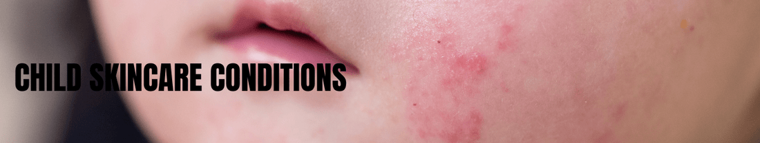 Child Skincare Conditions - Brandlistry Nigeria