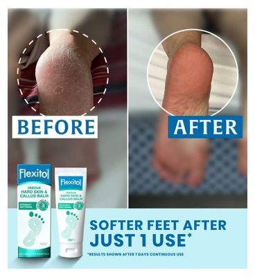 Flexitol Rescue Hard Skin & Callus Balm 56g