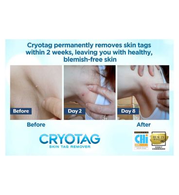 Cryotag Skin Tag Remover