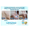 Cryotag Skin Tag Remover