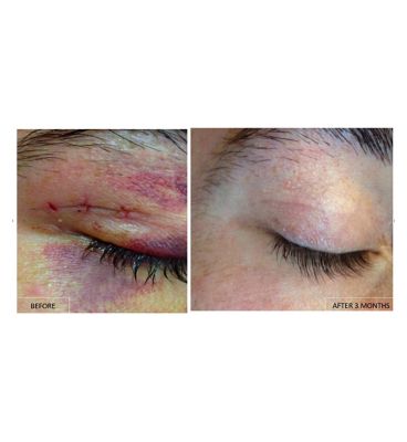 Kelo-Cote Scar gel - 6g
