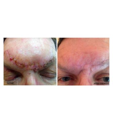 Kelo-Cote Scar gel - 6g