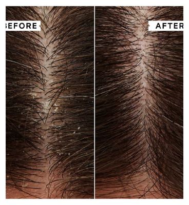 Philip Kingsley Flaky/Itchy Scalp Mask 20ml x 2