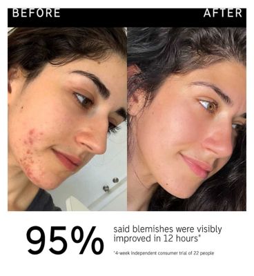 The INKEY List™ Succinic Acid Treatment 15ml