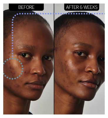 The INKEY List™ SuperSolutions 20% Niacinamide Serum 30ml