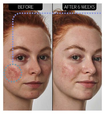 The INKEY List™ SuperSolutions 10% Azelaic Acid Serum 30ml