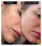 The INKEY List™ Blemish Clearing Moisturizer 2% NovoRetin 50ml