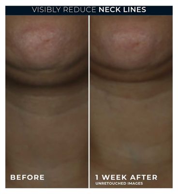 RoC Derm Correxion Retinol Contour Cream for Face, Neck & Jawline, Visible Facelift 50ml