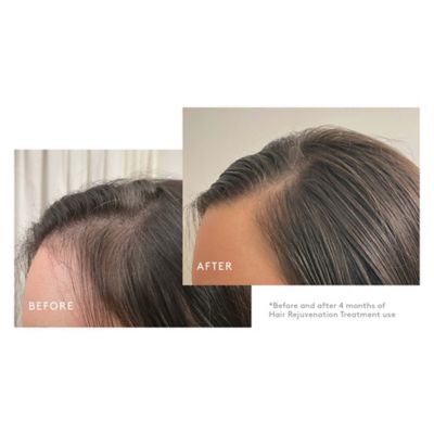 Virtue Hair Rejuvenation Treatment Kit (Phyto-Follicle Nutrient) Full Size, 90 day  (INTL)
