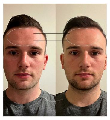 BEAUTYPRO PHOTON LED Light Therapy Facial Mask