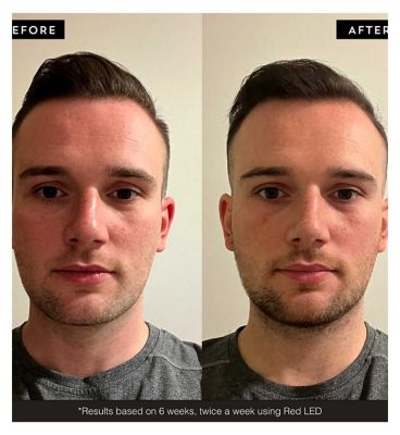 BARBER PRO PHOTON LED Light Therapy Facial Mask