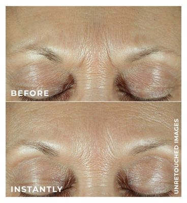 RoC Retinol DERM CORREXION® Fill+Treat Serum 15ml