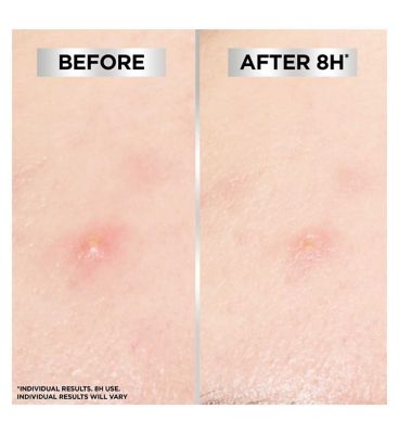 Garnier Pure Active 8hr Invisible Hydrocolloid Blemish Patch - 44 Patches