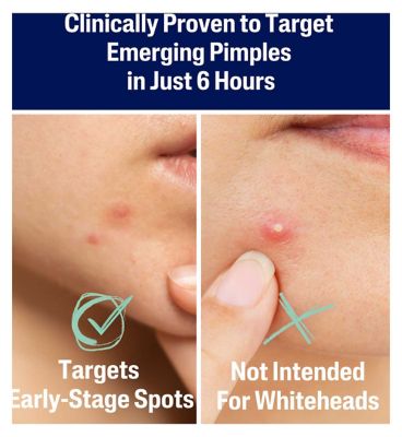 Cetaphil Gentle Clear Pimple Patches, 6 Hour Fast Clear with Salicylic Acid for Blemish-Prone Skin, 24 Emerging Spot Patches